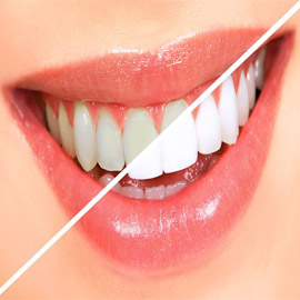 إليكم 4 طرق منزلية فعالة لتبييض الأسنان