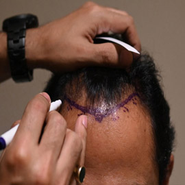 يجريها هواة على يوتيوب! عملية زراعة الشعر تتسبب بمقتل رجل هندي