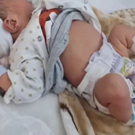 حالة نادرة جدا.. ولادة طفل يحمل توأمه في بطنه!