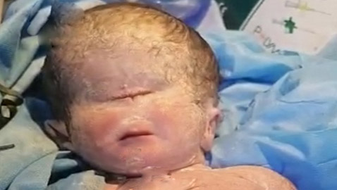 صور صادمة لولادة طفل بعين واحدة في العراق.. والطب يوضح
